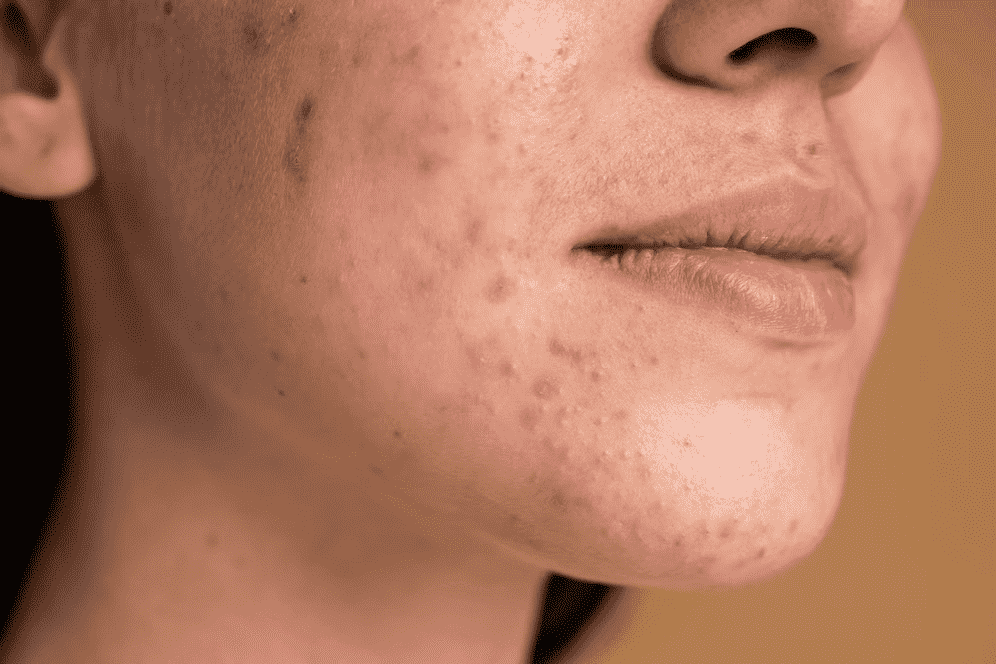 How to Build a Skincare Routine for Oily Skin